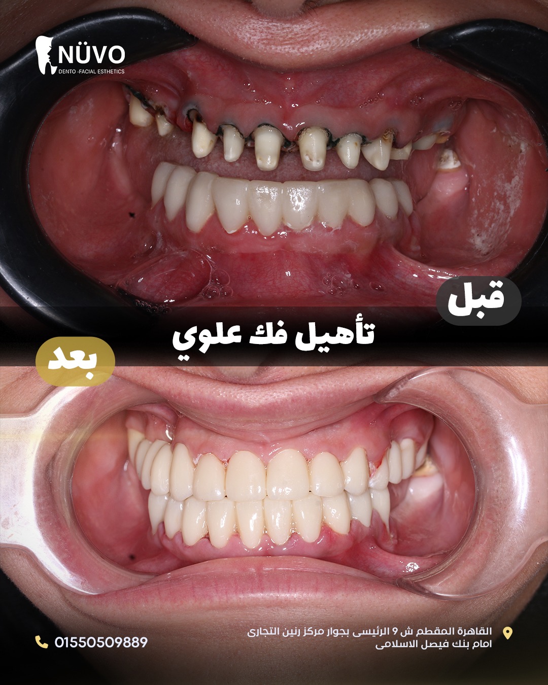Full Jaw Rehabilitation Cases